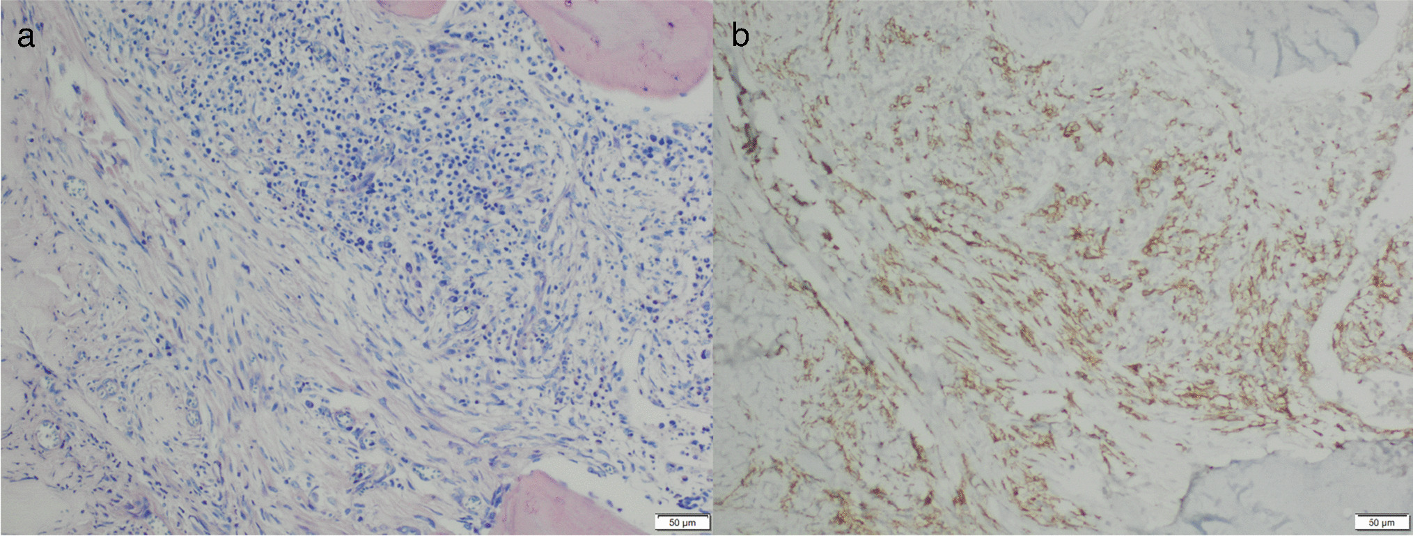 Sensitive and reliable detection of KIT p.D816V mutation in decalcified archival bone marrow trephines