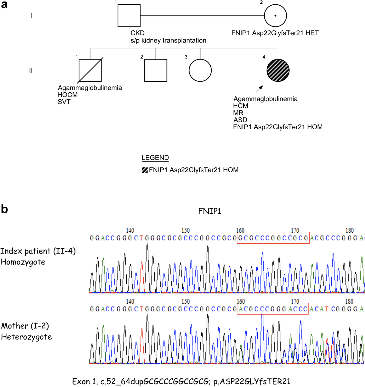 A novel mutation in FNIP1 associated with a syndromic immunodeficiency and cardiomyopathy