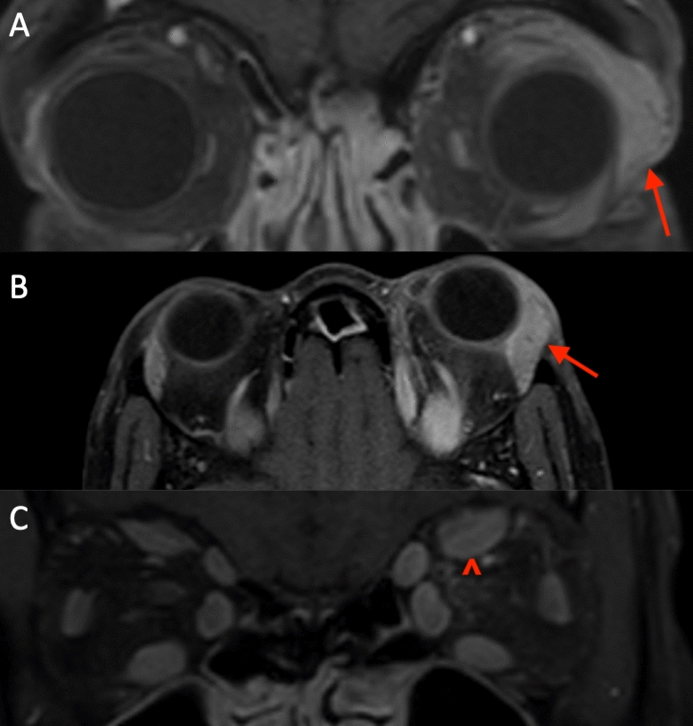 Lacrimal gland enlargement in thyroid eye disease