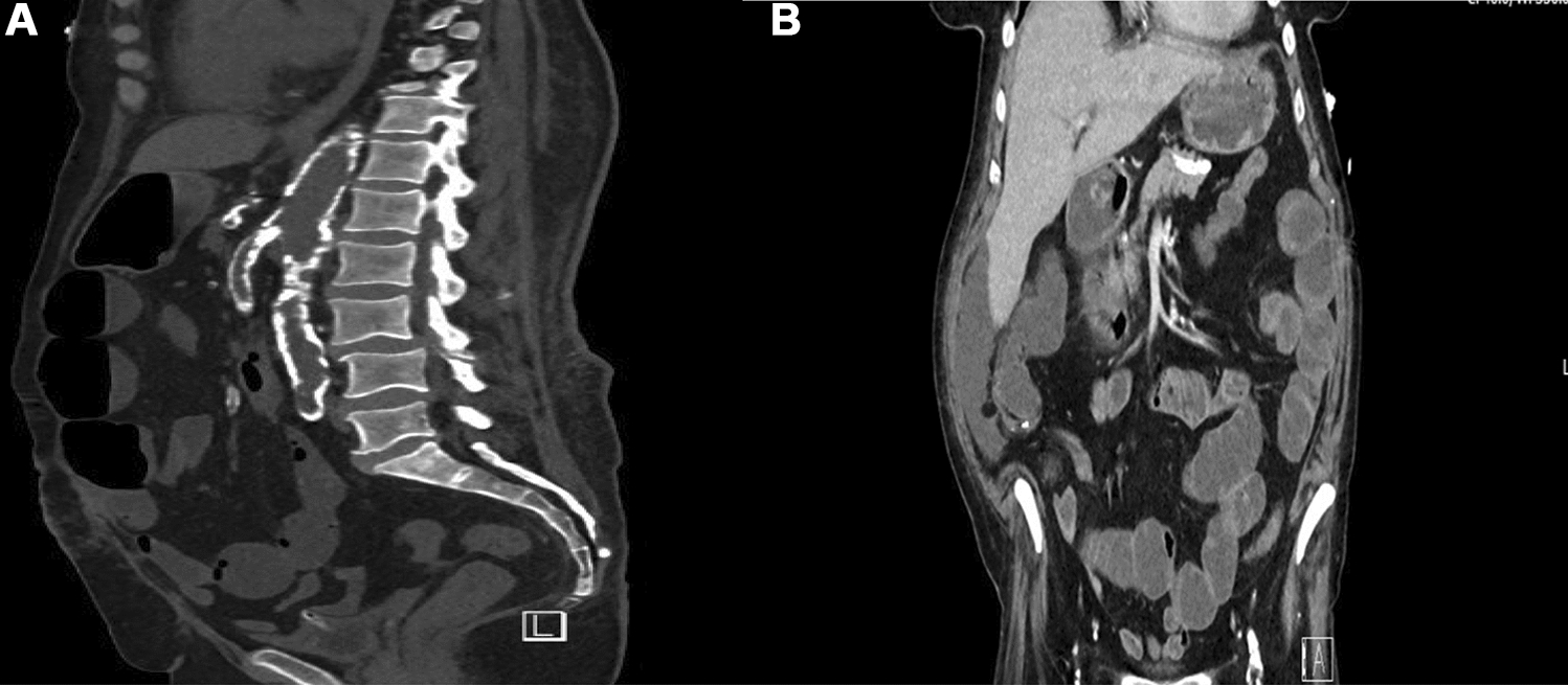 Gastrointestinal calciphylaxis: a rare and devastating complication in end-stage kidney disease