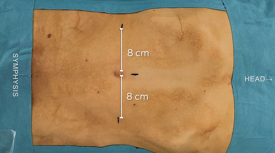 Robotic minimally invasive inguinal hernia repair with the Dexter robotic system™: A prospective multicenter clinical investigation