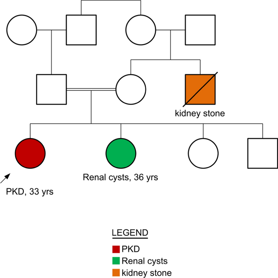 Autosomal recessive polycystic kidney disease: late-onset renal enlargement and proteinuria with rare PKHD1 mutation—a case report