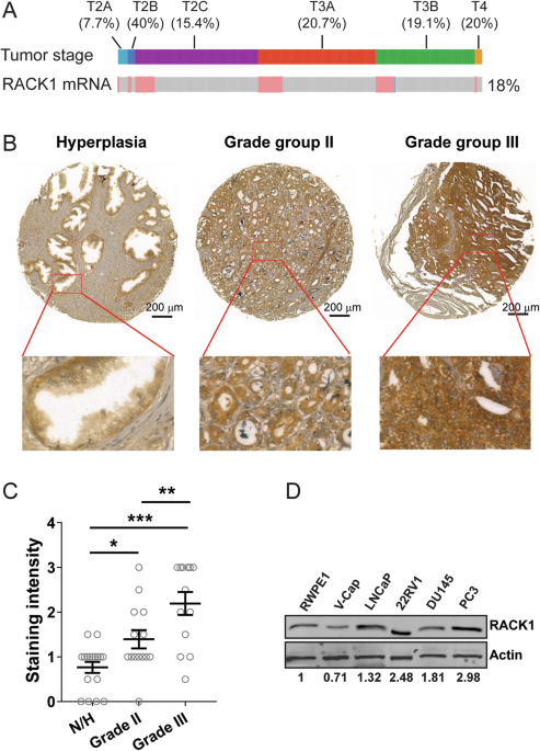 Unveiling RACK1: a key regulator of the PI3K/AKT pathway in prostate cancer development