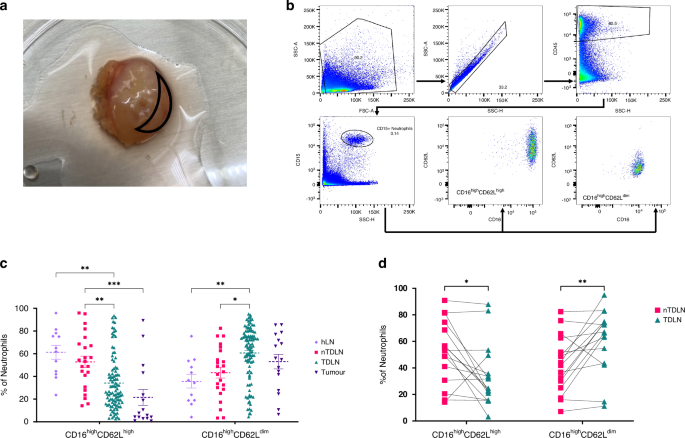 Phenotypical differences of neutrophils patrolling tumour-draining lymph nodes in head and neck cancer