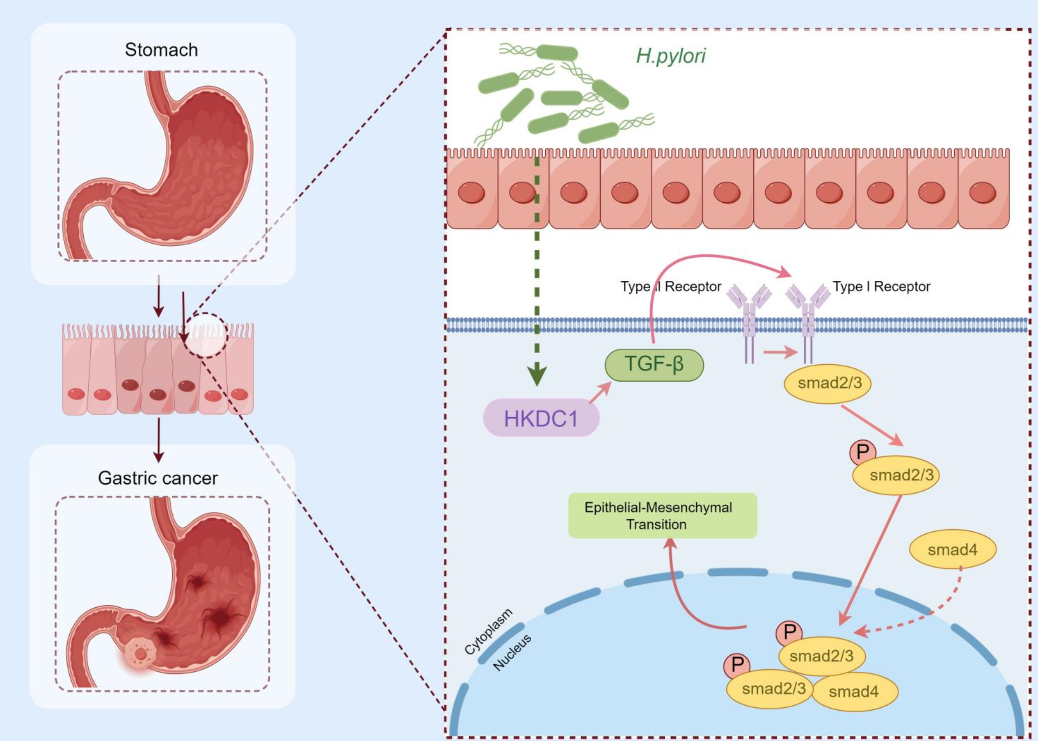 Helicobacter pylori promotes gastric cancer progression by activating the TGF-β/Smad2/EMT pathway through HKDC1