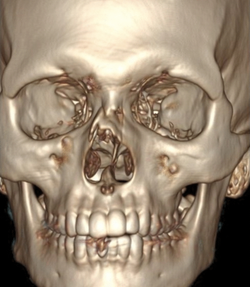 A Novel Nasal Splint with Airway for Closed Management of Comminuted Nasoseptal Injury