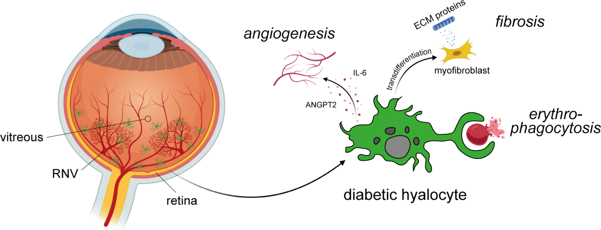 The multifaceted role of vitreous hyalocytes: Orchestrating inflammation, angiomodulation and erythrophagocytosis in proliferative diabetic retinopathy