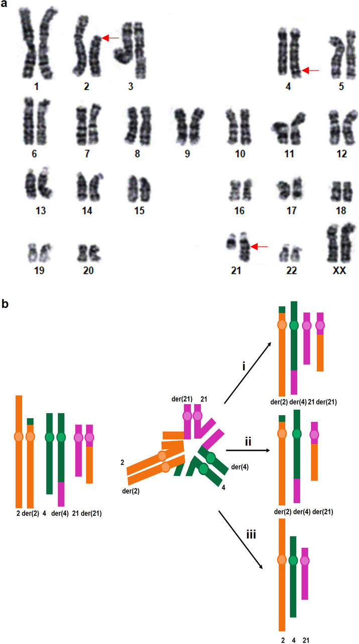 Complex chromosomal rearrangements in female carriers experiencing recurrent pregnancy loss or poor obstetric history and literature review