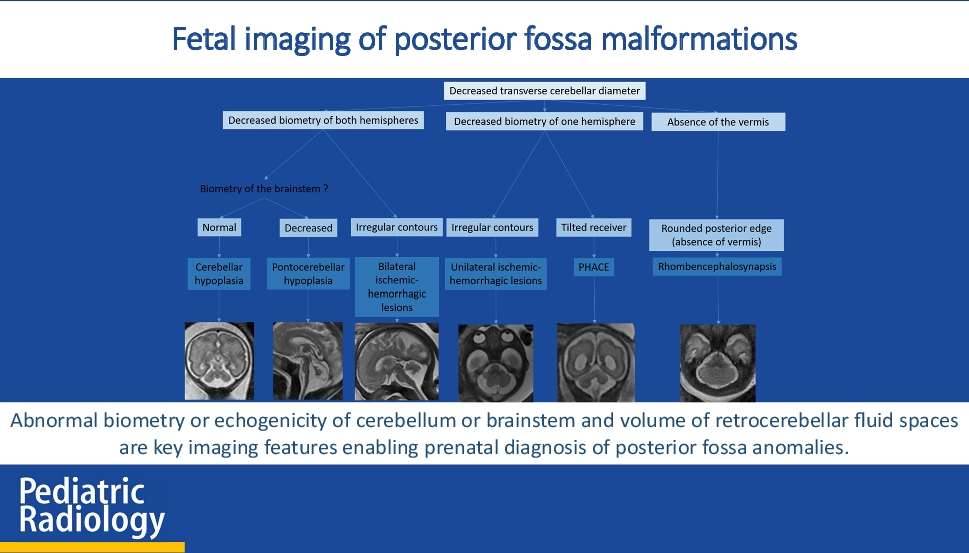 Fetal imaging of posterior fossa malformations