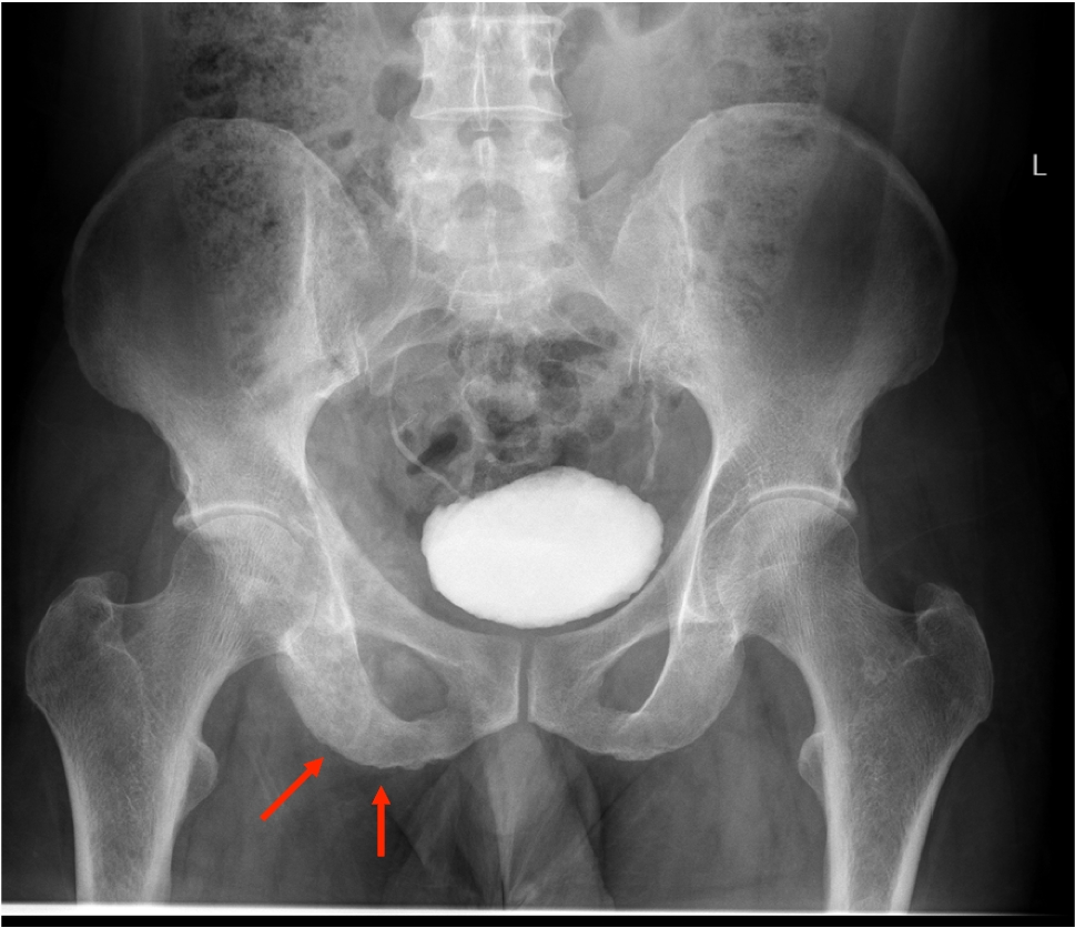 Answer To Test Yourself Answer: Radiation-induced osteosarcoma with right common iliac vein tumor thrombus