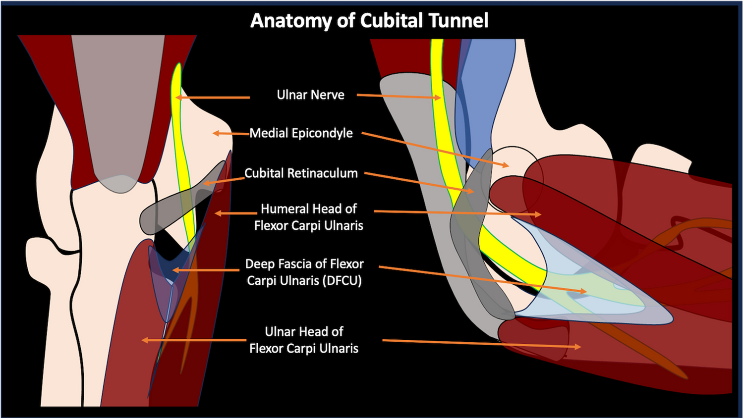 Cubital tunnel syndrome: anatomy, pathology, and imaging