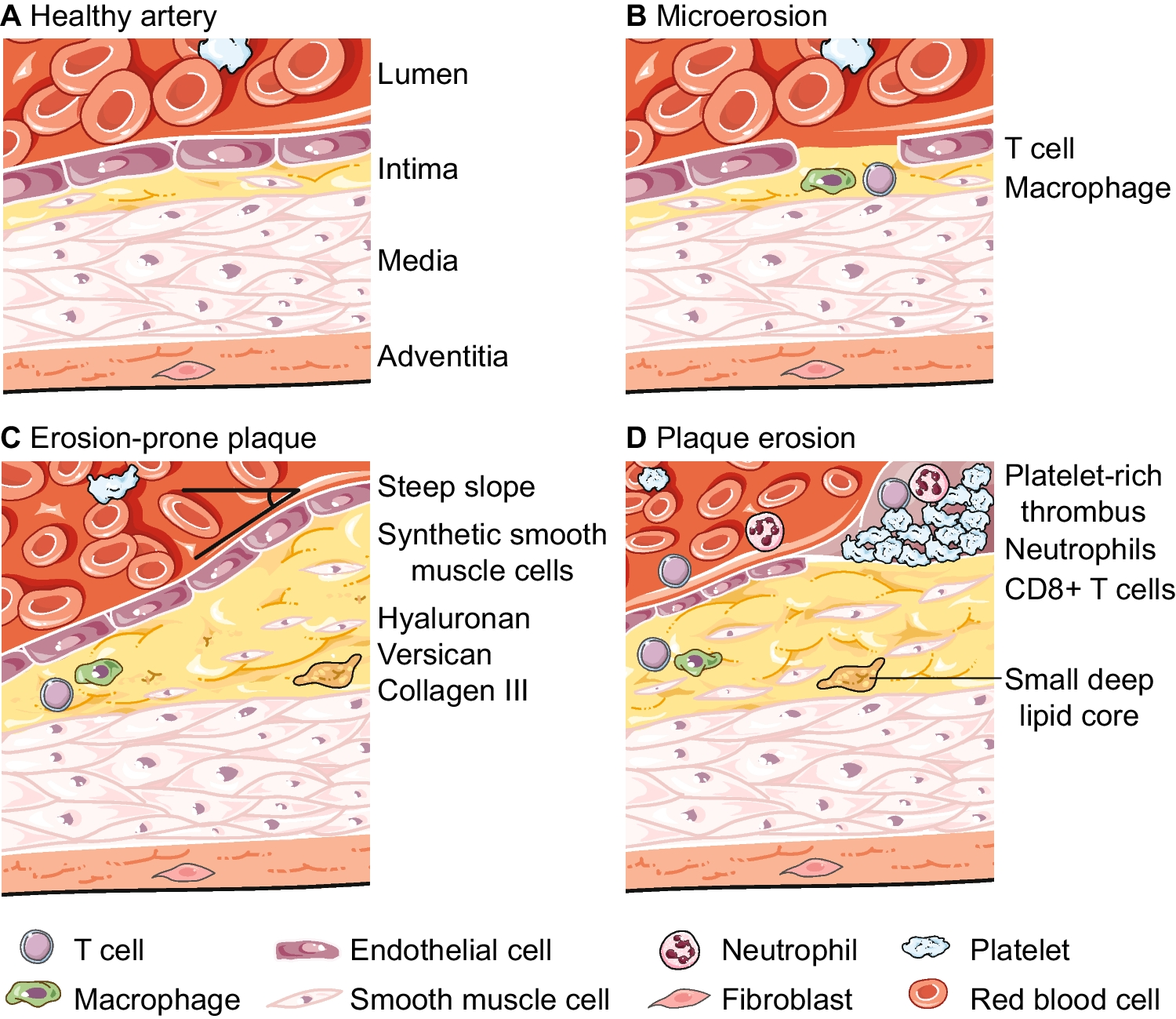 Erosion of the Atheroma: Wicked T Cells at the Culprit Site