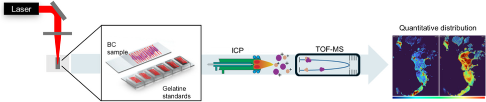 Quantitative distribution of essential elements and non-essential metals in breast cancer tissues by LA-ICP-TOF–MS