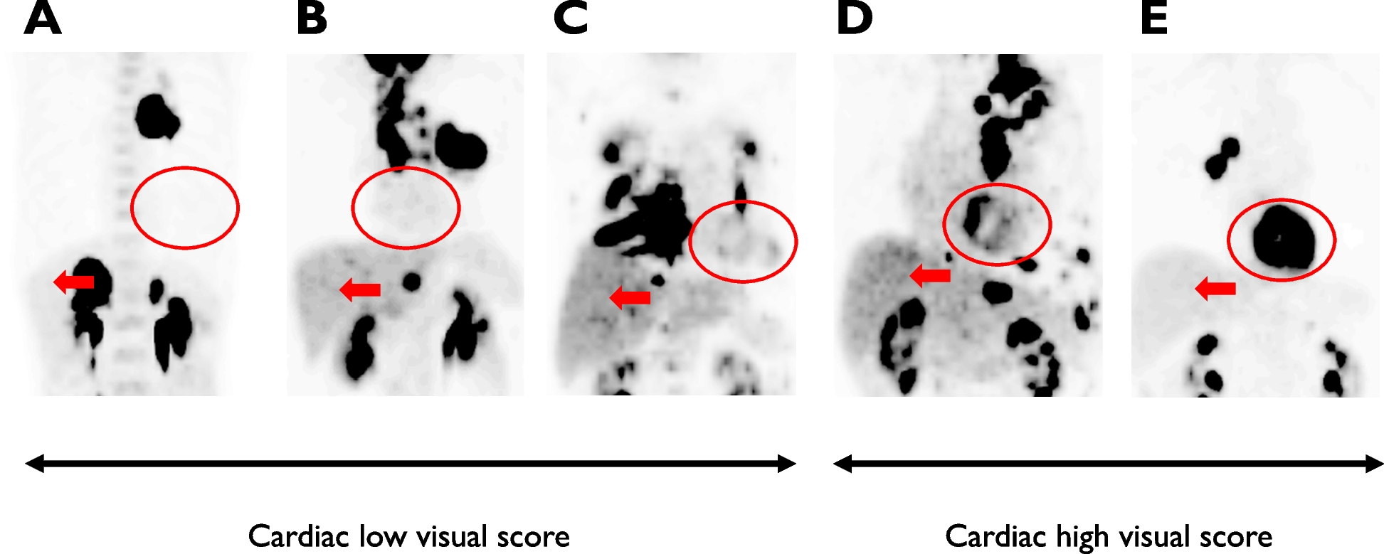 Clinical significance of visual cardiac 18F-FDG uptake in advanced non-small cell lung cancer