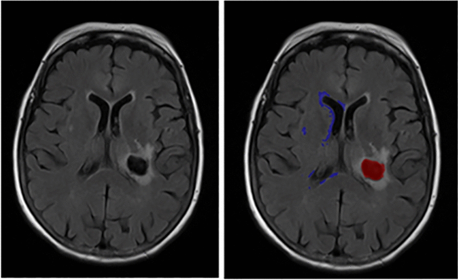 Neuroimaging Markers of Brain Reserve and Associations with Delirium in Patients with Intracerebral Hemorrhage