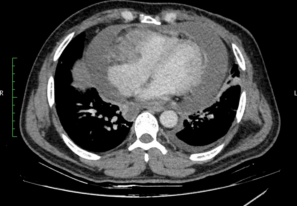 Cardiac Metastases in Head & Neck Cancer Presenting as Paraneoplastic Syndrome: A Case Report Demanding Introspection