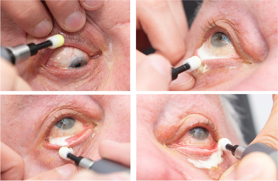 BlephEx-treatment for blepharitis: a prospective randomized placebo-controlled trial