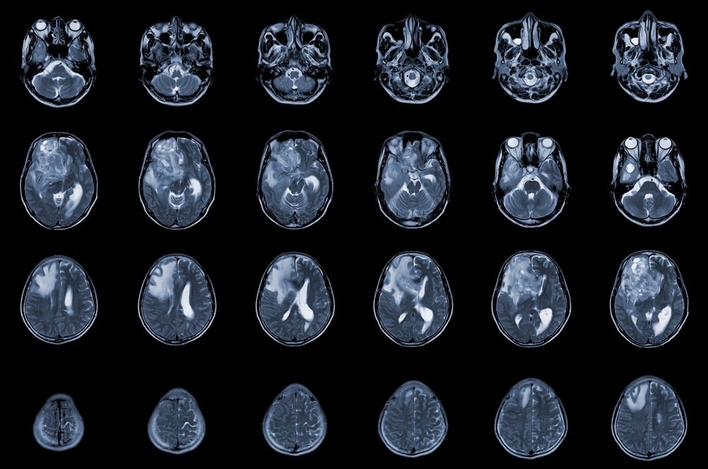 Small brain-penetrating molecule offers hope for treating aggressive brain tumors