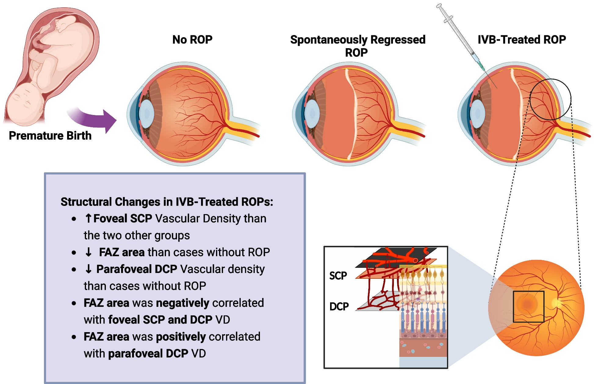 The macular microvascular changes in children with a history of retinopathy of prematurity treated with intravitreal Bevacizumab injection using optical coherence tomography angiography: a retrospective cohort