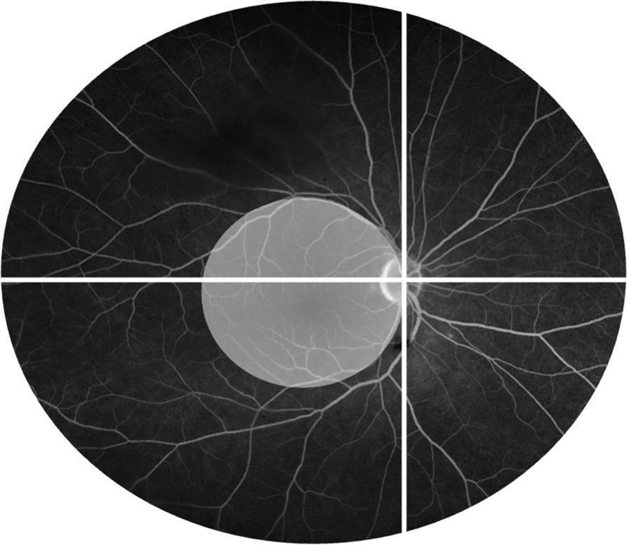 Long-term effects of tocilizumab on retinal and choroidal inflammation in Birdshot uveitis