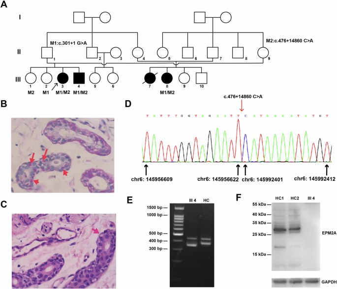 Identification of biallelic intronic EPM2A mutations in a Lafora disease kindred