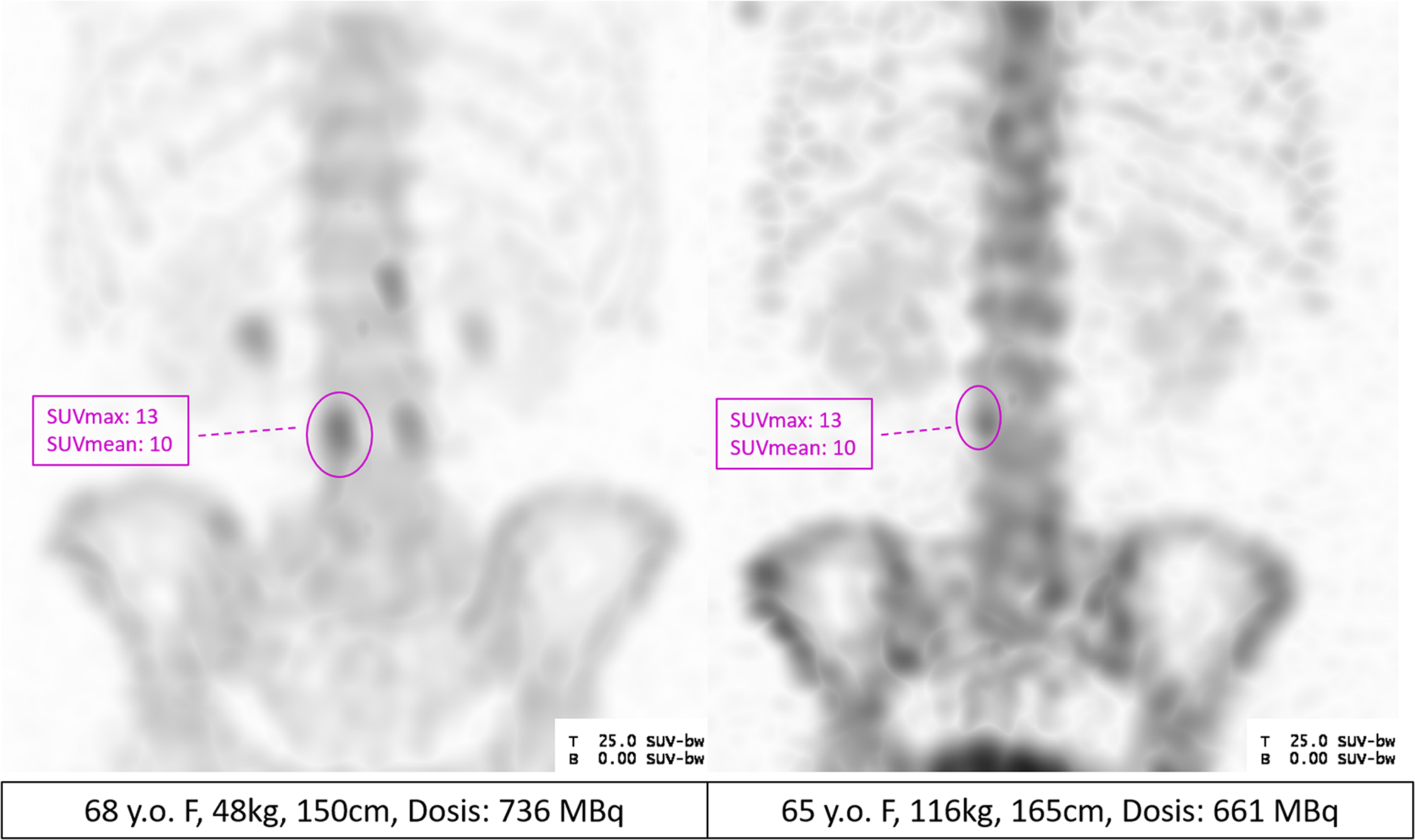 Quantification of [99mTc]Tc-HDP bone SPECT/CT: can we improve the body weight based standardized uptake value with a more robust normalization?