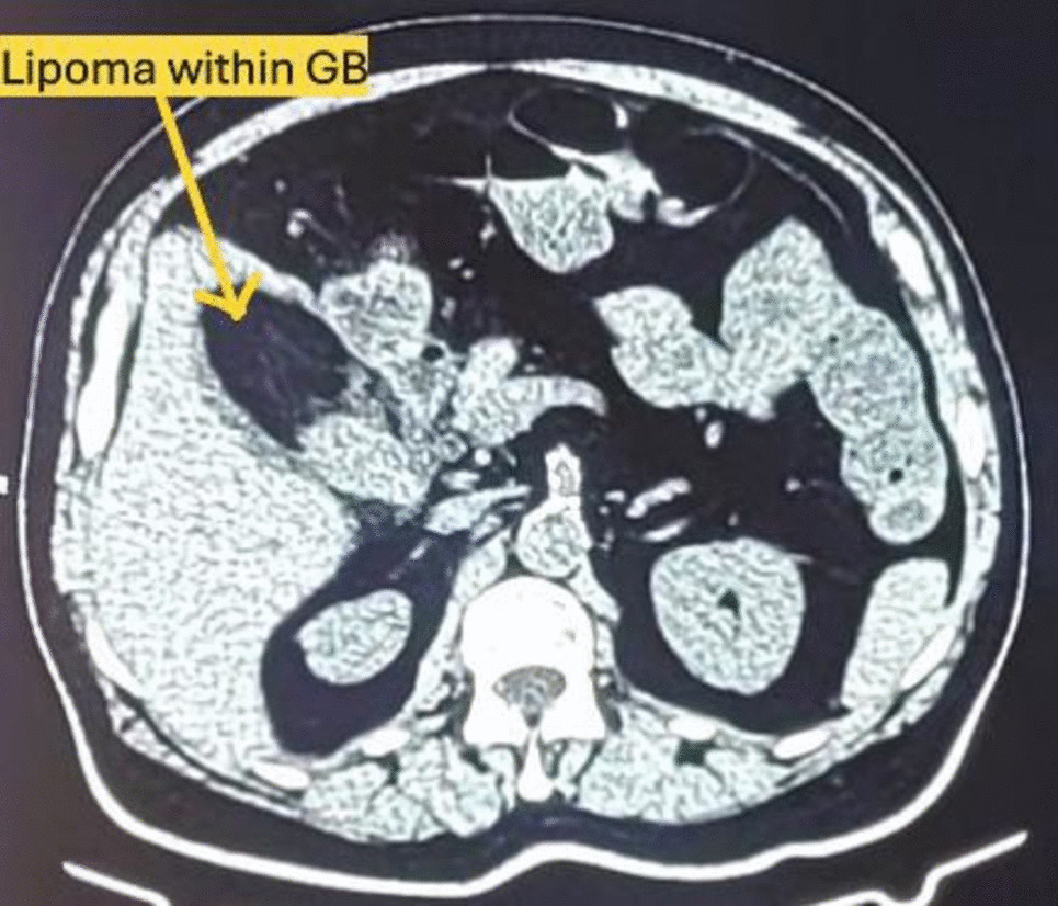 Gall Bladder Lipoma -A Rare Mesenchymal Tumour of Gall Bladder