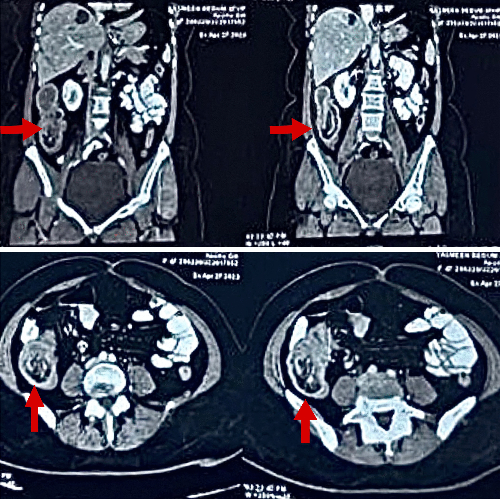 Vanek’s Tumor Causing Dual Intussusception- a Case Report and Literature Review