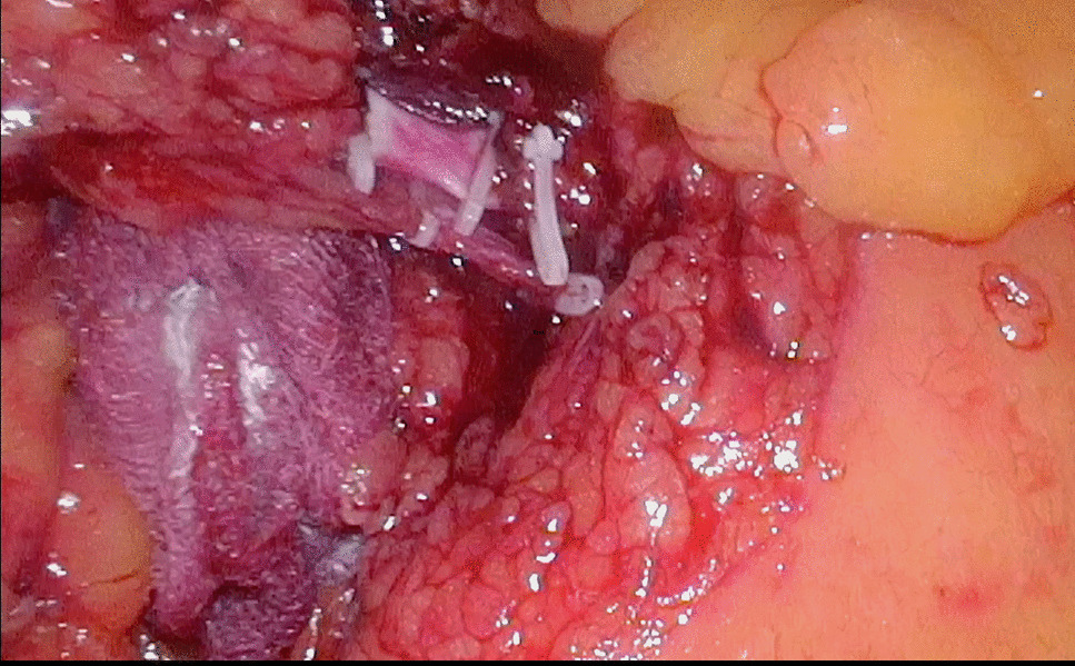 Improved Nodal Yields in Laparoscopic Right Hemicolectomy Using Intracorporeal Technique—A Comparative Study