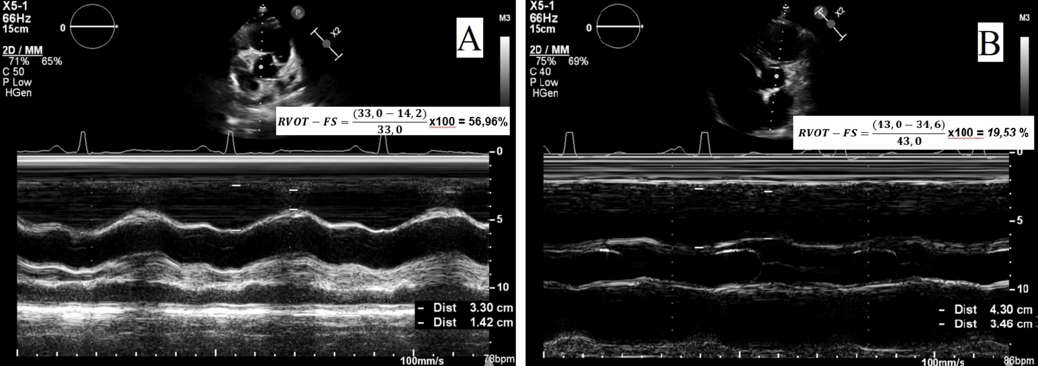 Right ventricular outflow tract fractional shortening: a novel diagnostic parameter for pulmonary hypertension