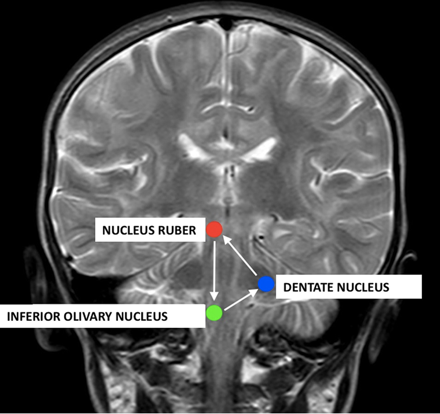 T2/FLAIR mismatch and diffusion restriction as novel pathophysiological markers in MRI evaluation of central tegmental tract hyperintensity in pediatric patients