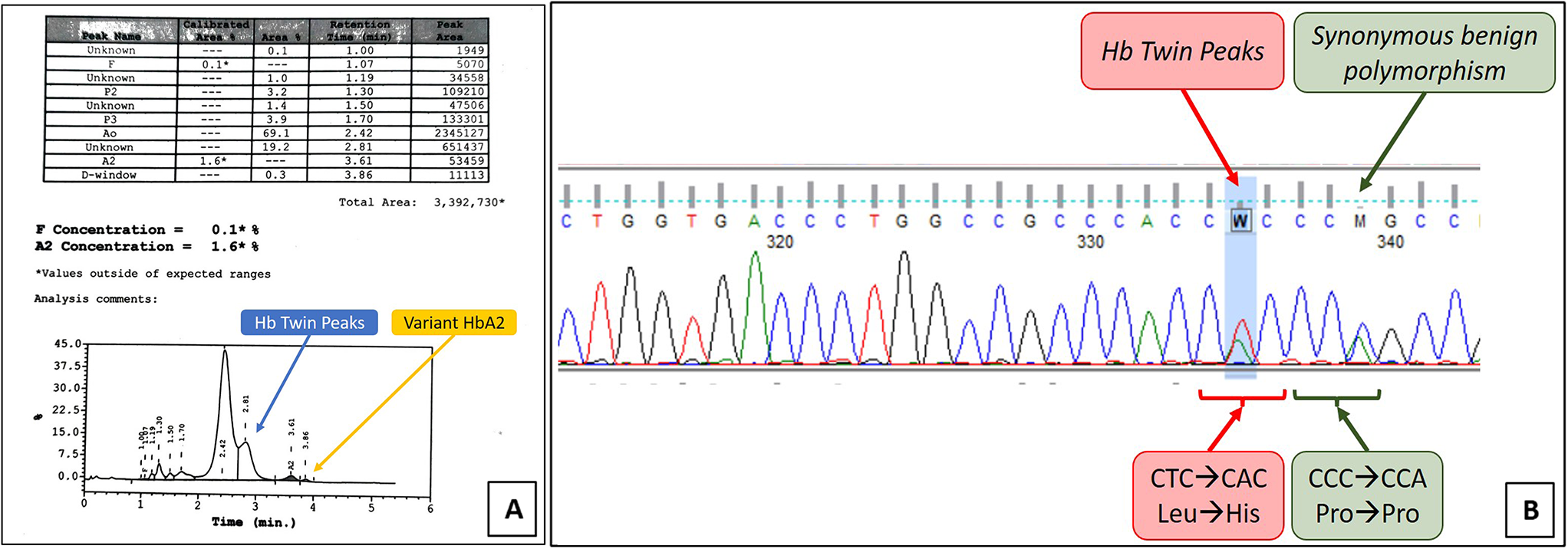 Detection of Hemoglobin Twin Peaks (HBA2:c.341T > A) in a Family During Antenatal Work-Up: A Case Report Documenting a Rare Entity and its Diagnostic Dilemma