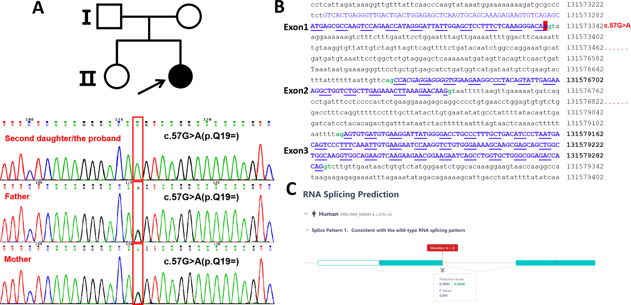 Potential role of ARG1 c.57G > A variant in Argininemia