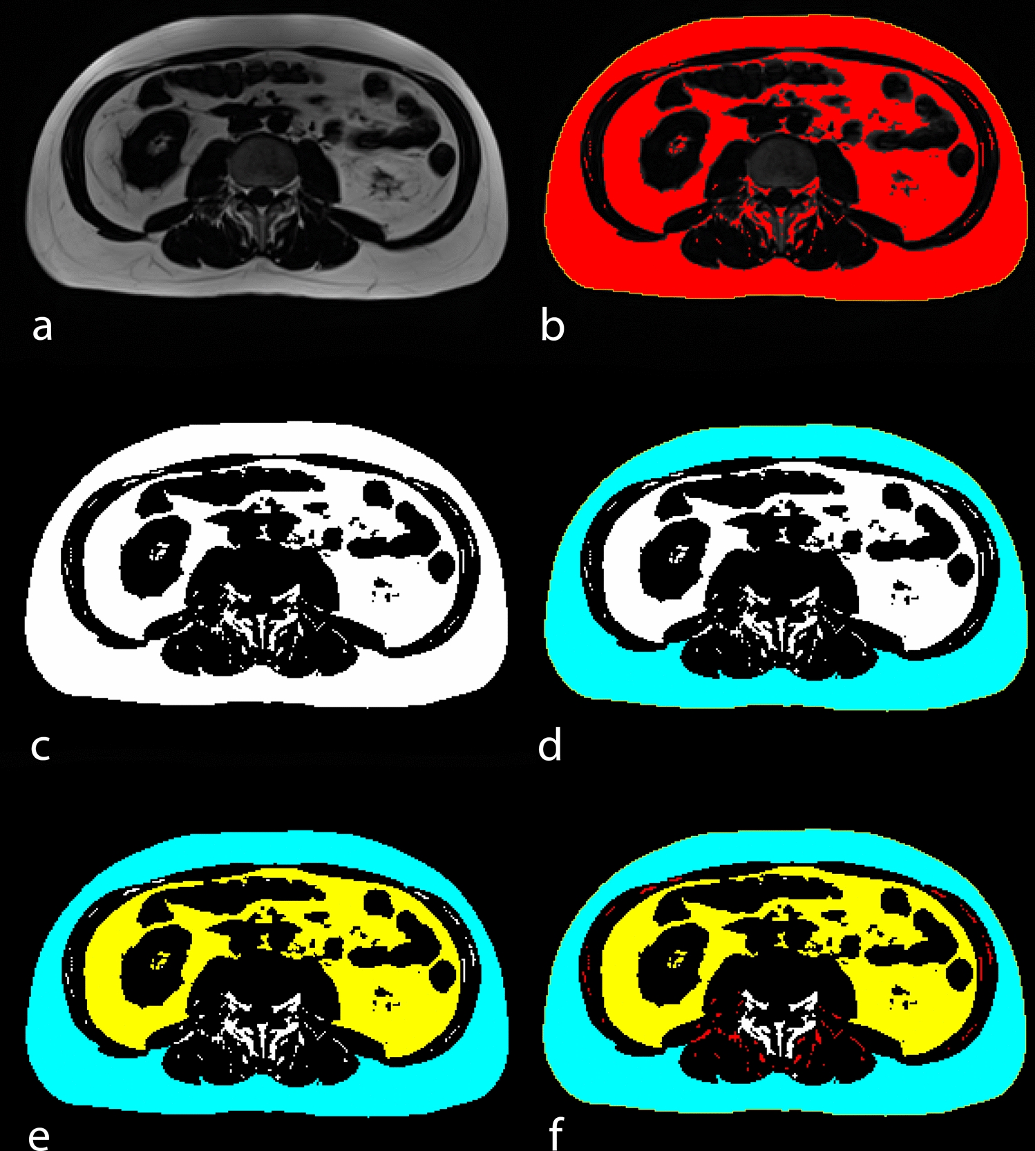 Impact of body fat composition on liver iron overload severity in hemochromatosis: a retrospective MRI analysis