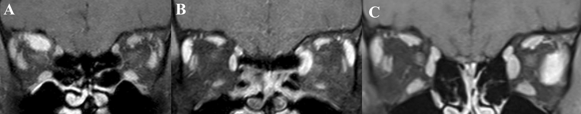 Patterns of recurrence in idiopathic orbital myositis