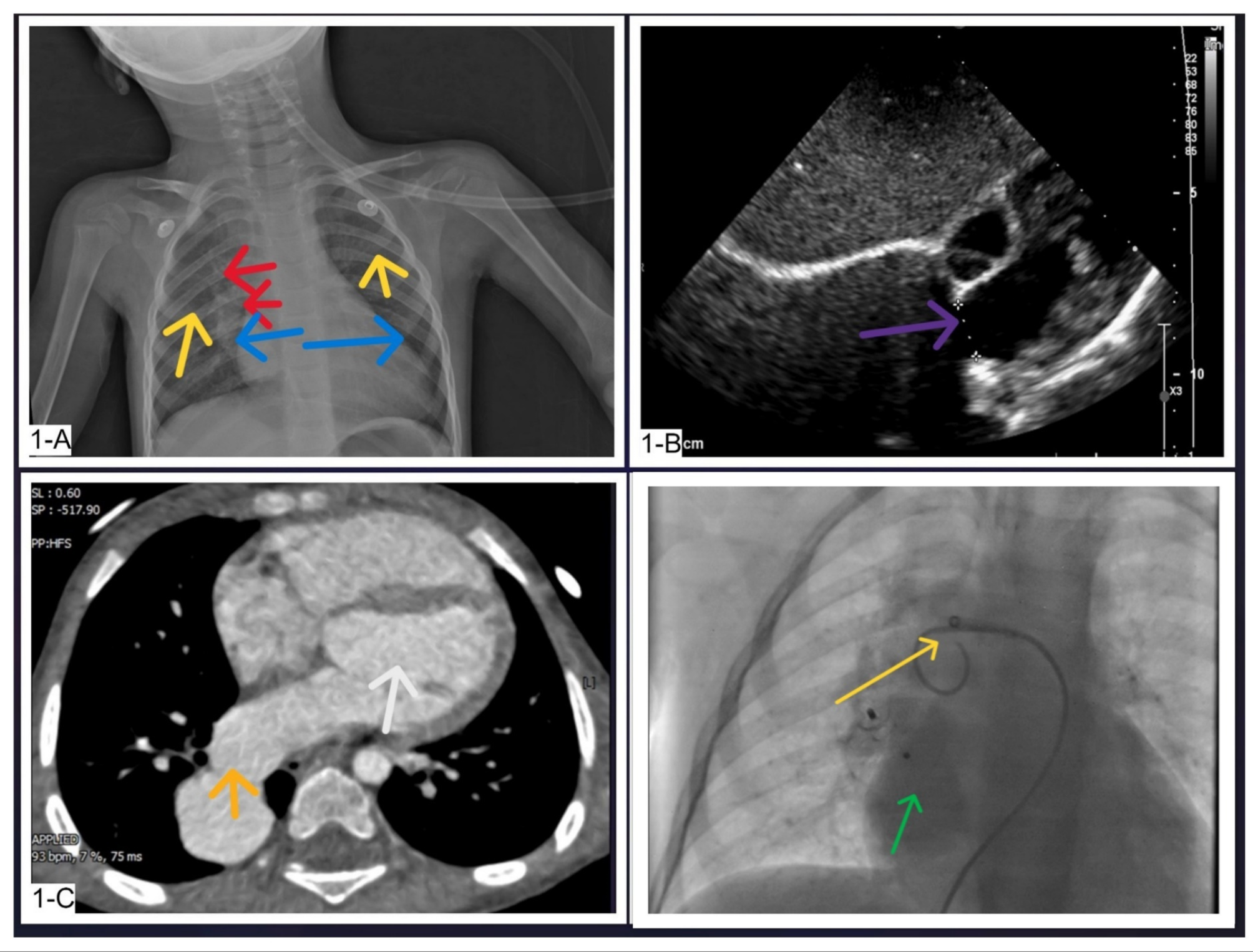 Successful transcatheter treatment of large right pulmonary artery to left atrial fistula: a case series and literature review