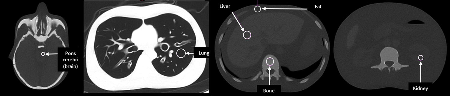 CT radiation dose reduction with tin filter for localisation/characterisation level image quality in PET-CT: a phantom study