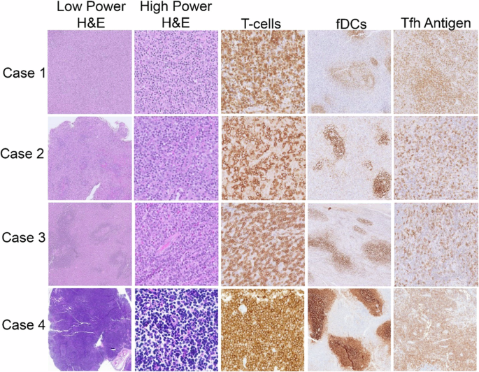 Indolent nodal T follicular helper cell lymphomas—A case series