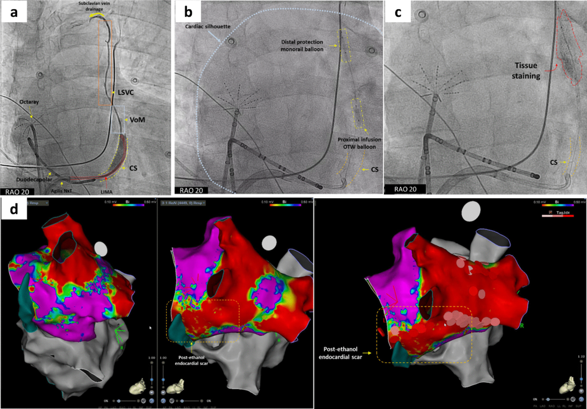 Double-balloon distal protection for vein of Marshall ethanol infusion in presence of persistent left superior vena cava