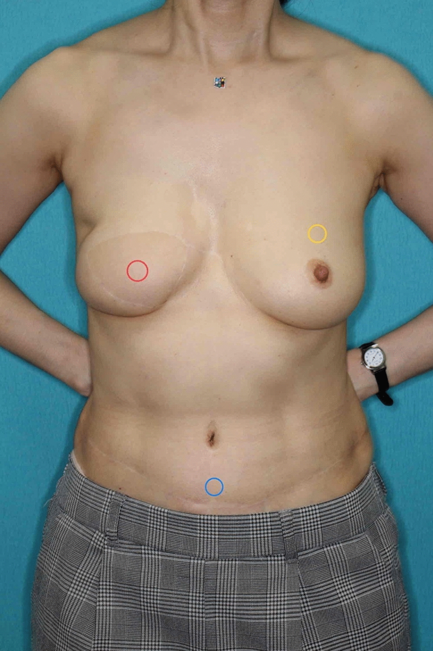 Color differences of skin paddles using the free flap for autologous breast reconstruction in Asian patients