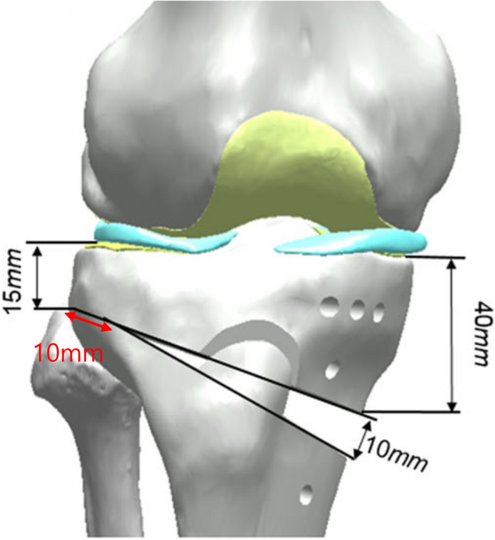 Biomechanical evaluation of a newly designed locking plate for opening wedge high tibial osteotomy: stress distribution and stability in the presence of lateral hinge fracture