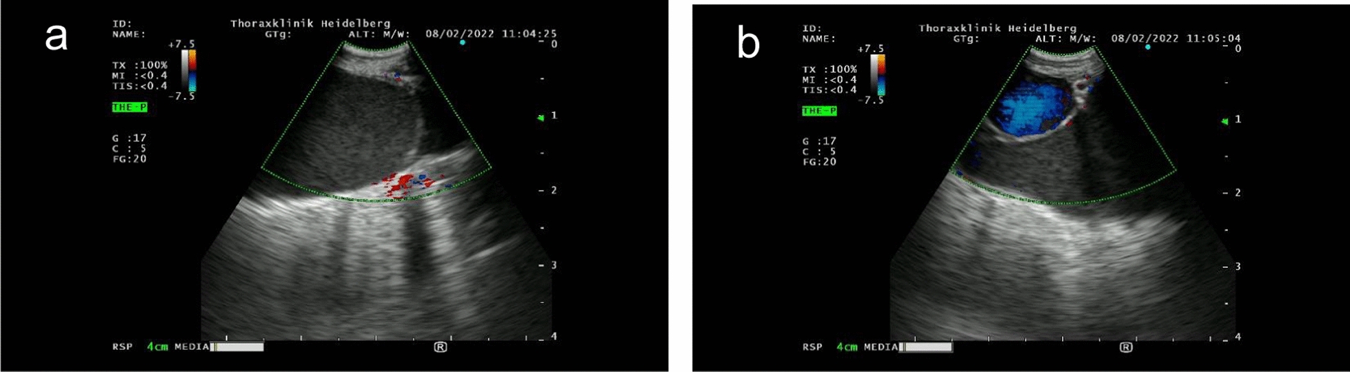 Pulmonary lymphangiomatosis: insights into an ultra-rare disease