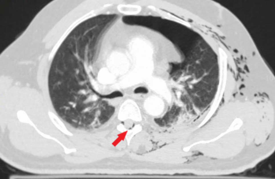 Air Within The Spinal Canal: Epidural Pneumorrhachis