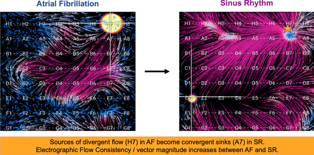 A single-center trial of electrographic flow mapping and concomitant voltage mapping in sinus rhythm and atrial fibrillation (FLOW EVAL-AF)