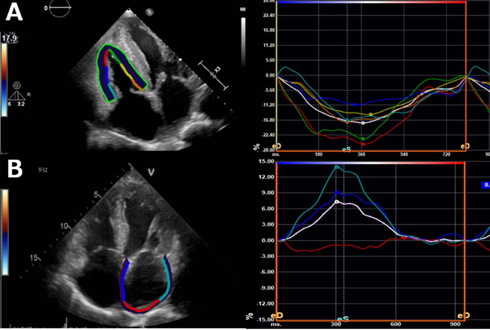 Recovery of right ventricular function in patients with transthyretin cardiac amyloidosis after one-year tafamidis administration