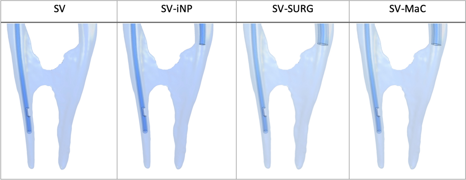 Computational fluid dynamics analysis of conventional irrigation and the combination with adjuvant suction cannulas in human molars with isthmus communication