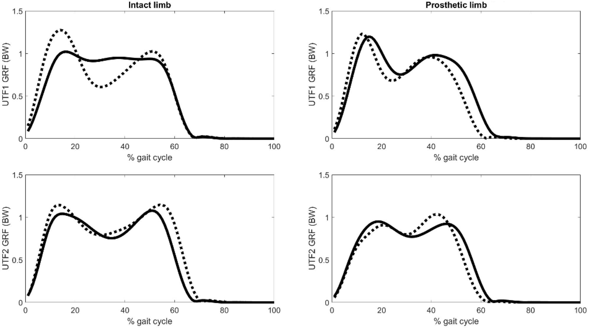 A one-year follow-up case series on gait analysis and patient-reported outcomes for persons with unilateral and bilateral transfemoral amputations undergoing direct skeletal fixation