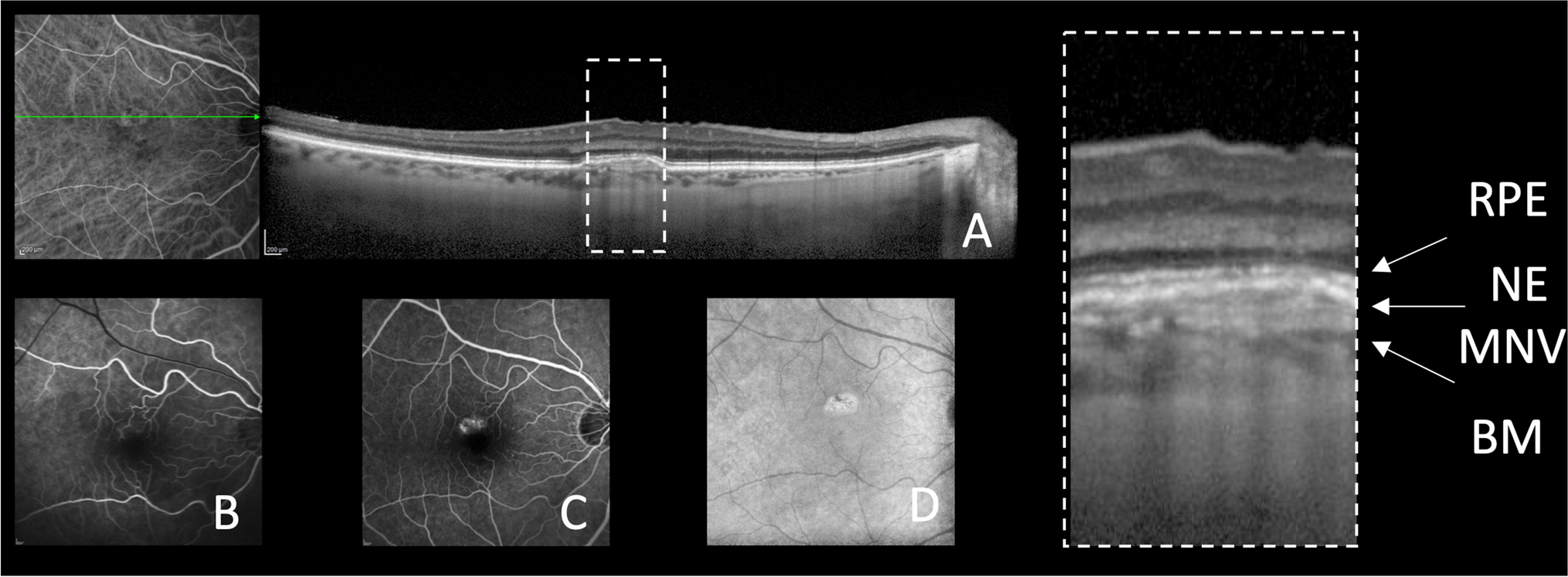 The “triple-layer sign”: an optical coherence tomography signature for the detection of non-exudative macular neovascularization