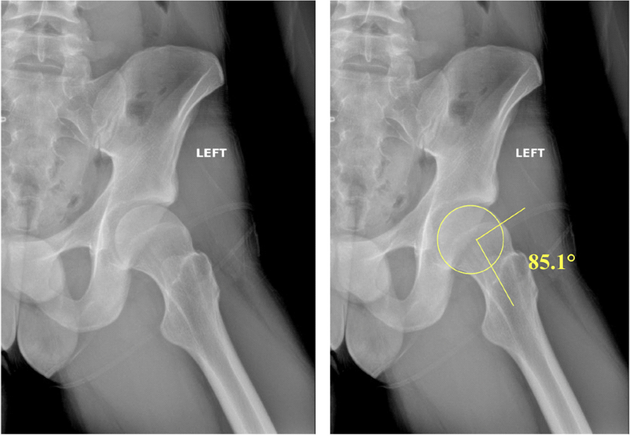 Hip Arthroscopy for Labral Tears and FAI is Associated with a High Rate of Return to Play for Professional American Football Athletes, A Literature Review