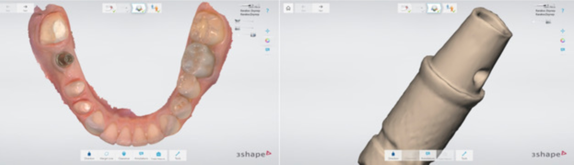 Replacement of a single-tooth implant restoration with the abutment dual-scanning technique: a case report